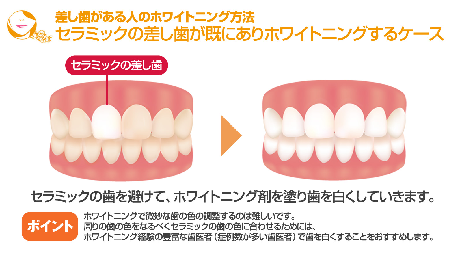 ホワイトニングでは白くならない 差し歯を白くする方法