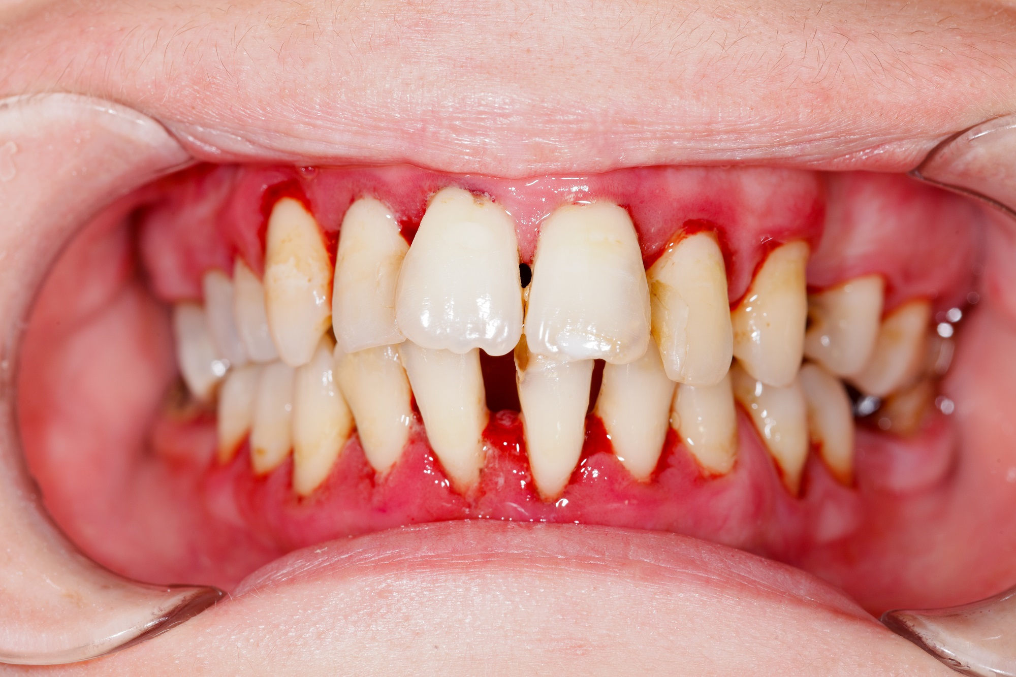 歯周病の人の歯