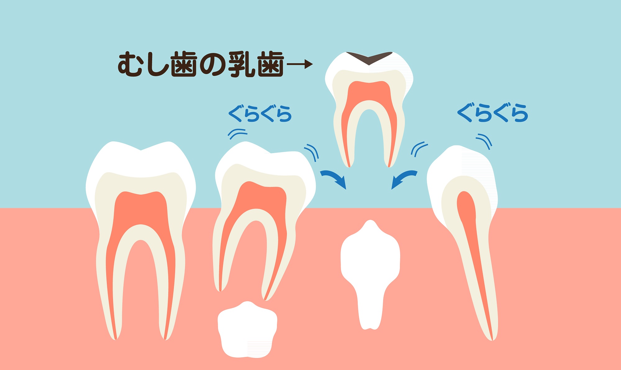 虫歯の乳歯