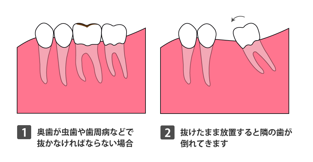 歯周病　歯が倒れる