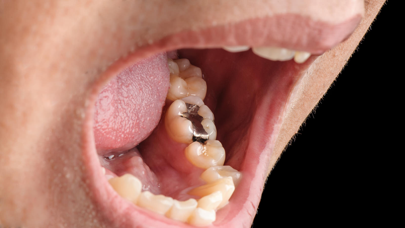 銀歯　失活歯　の人は歯のマニキュアがおすすめ