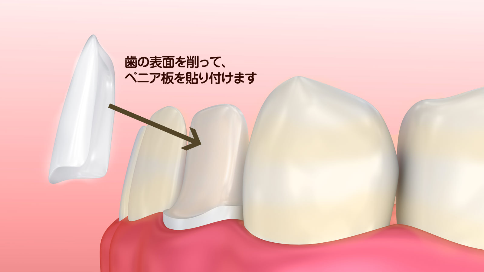 テトラサイクリンの歯を治すラミネートベニア