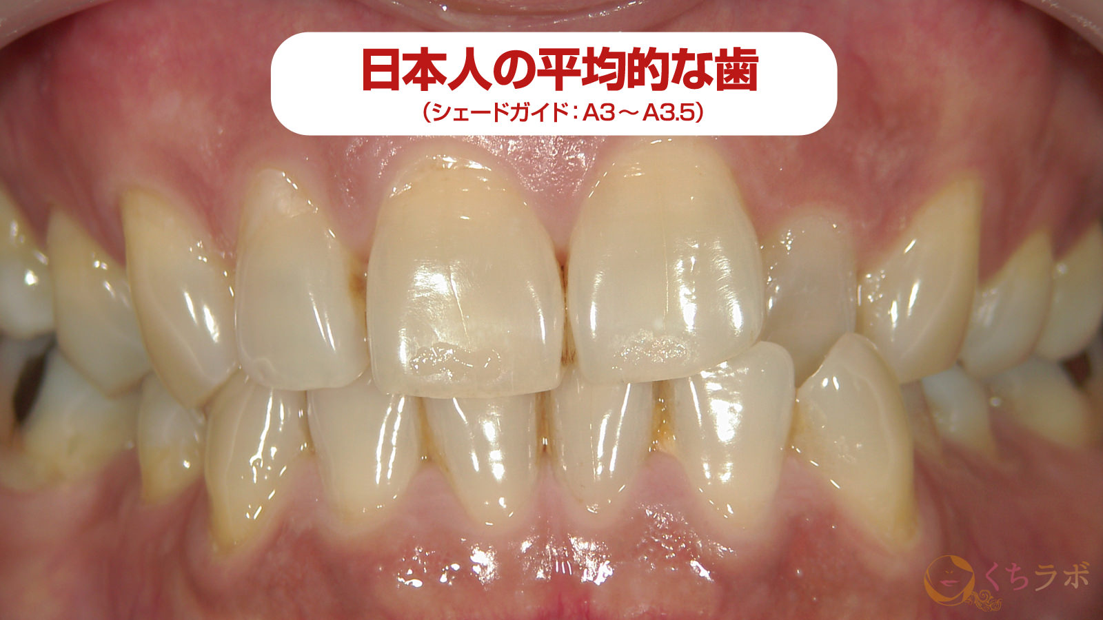 日本人の平均的な歯