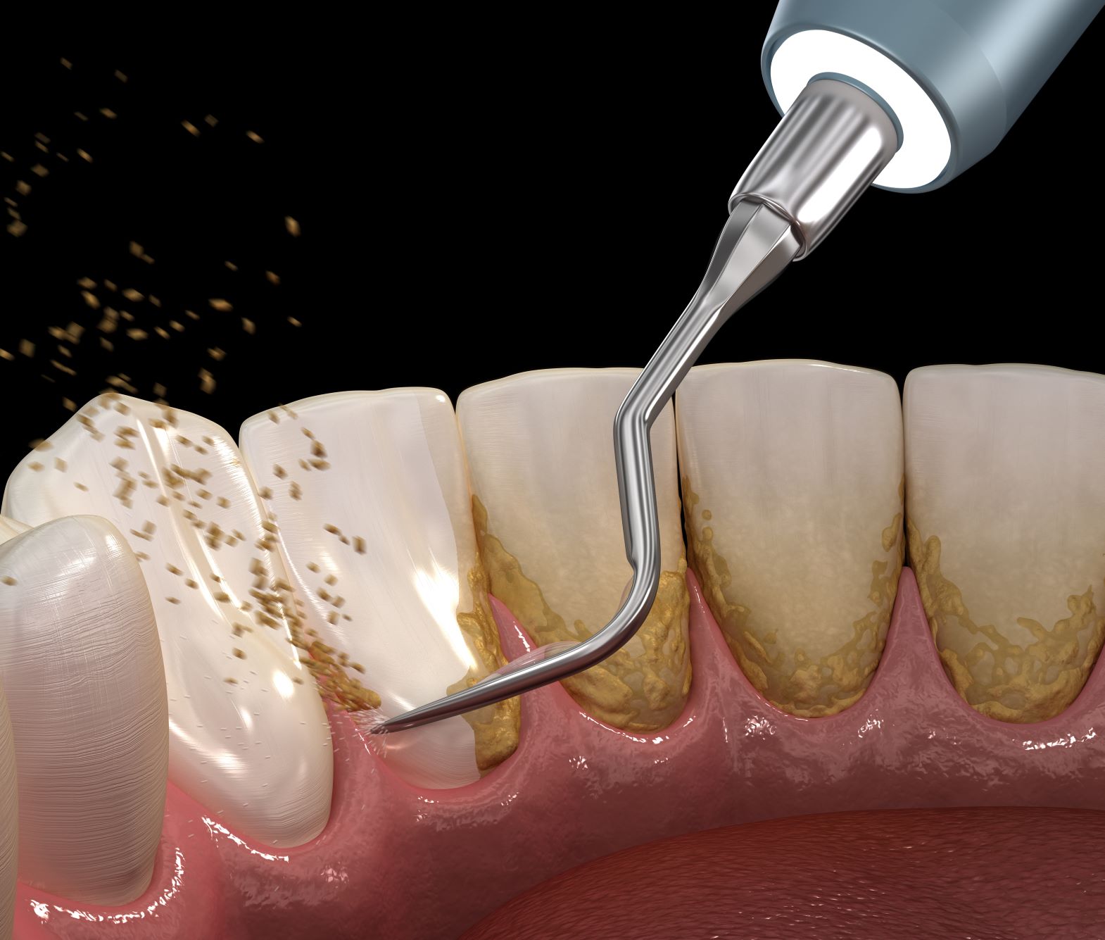 歯石 の 取り 方 歯医者