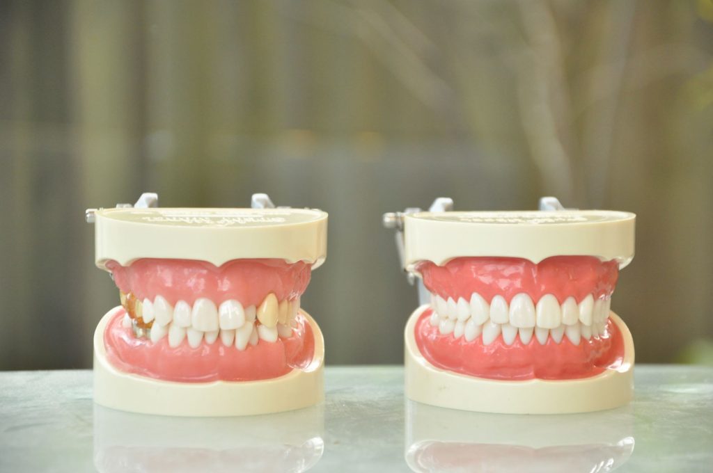 2つの歯の模型の写真