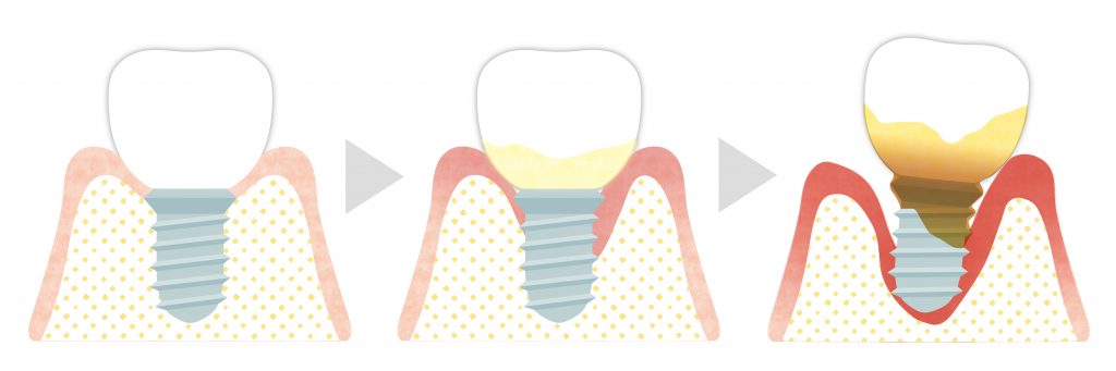 インプラント歯周炎の流れの画像