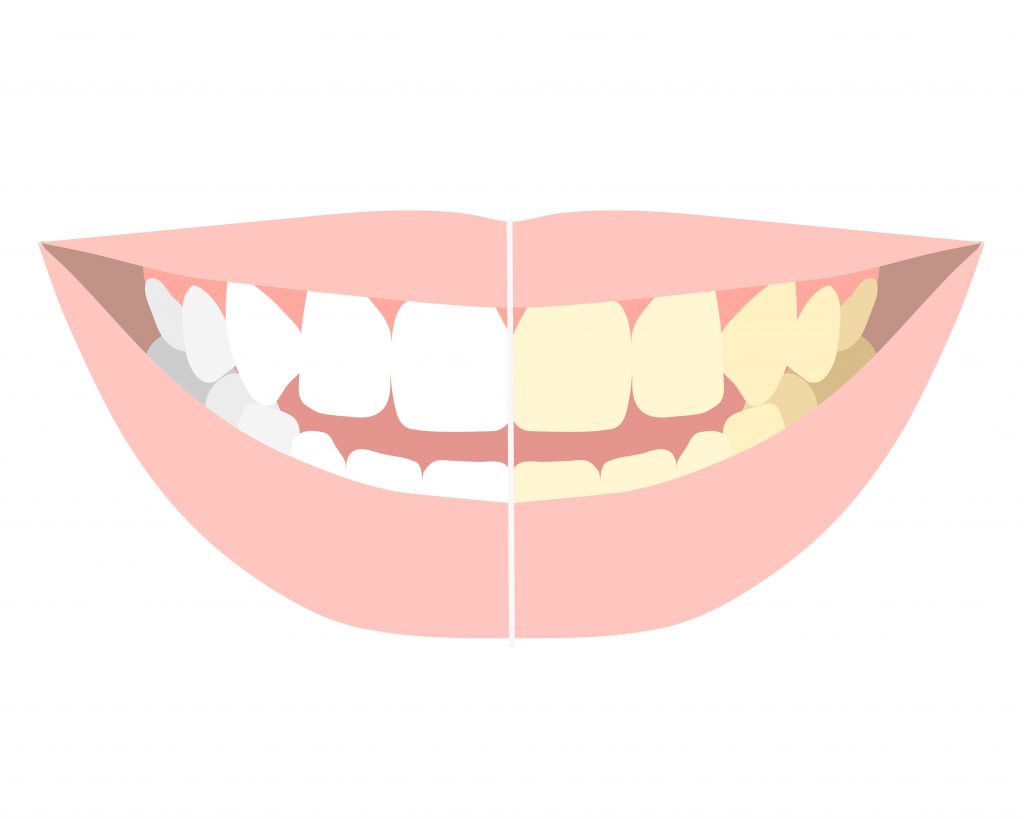 ホワイトニング_歯の着色の比較