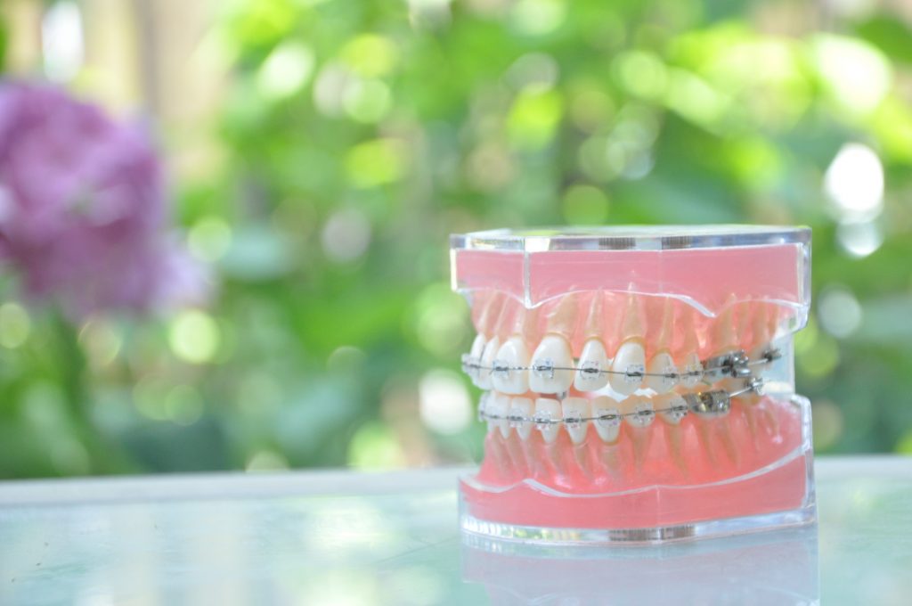 歯科矯正模型