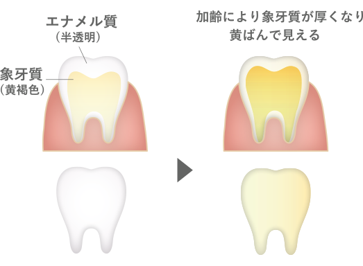 歯の黄ばみの原因を説明している写真