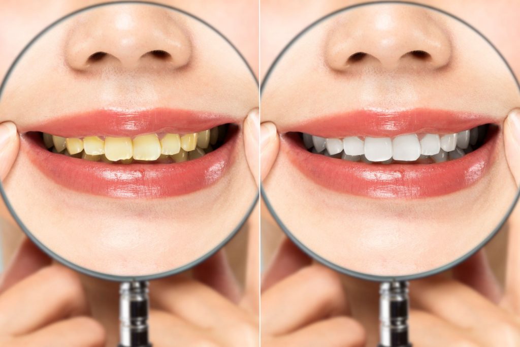 黄ばみと白い歯の比較写真
